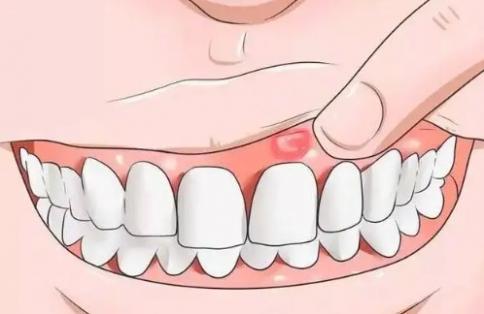 牙龈肿痛的原因是什么（牙龈肿胀和疼痛怎么办） 第3张