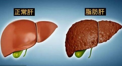 脂肪肝的症状是什么？（脂肪肝怎么调理好的快一些） 第2张