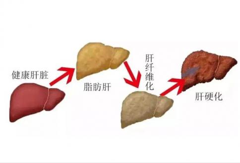 脂肪肝的症状是什么？（脂肪肝怎么调理好的快一些） 第3张